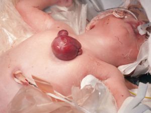 Tin mừng: Cứu sống bé sơ sinh có tim ngoài lồng ngực một cách kỳ diệu